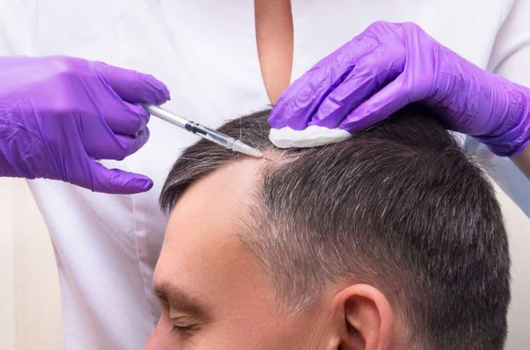 Transform Your Look with a Hair Transplant London Procedure